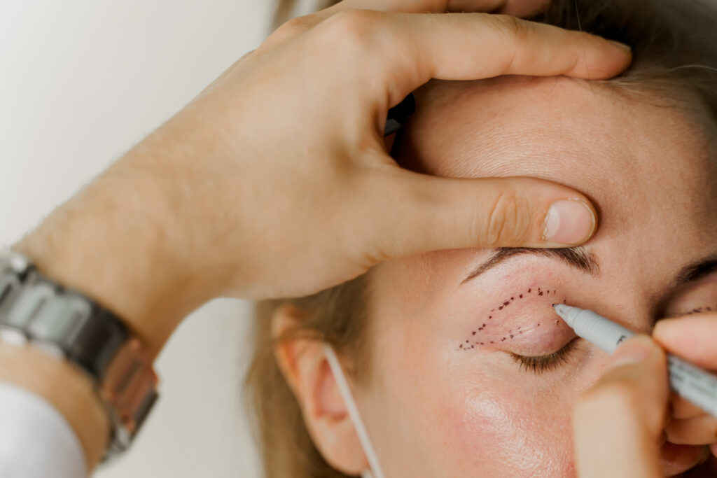 Blefaroplastie chirurgicala Craiova