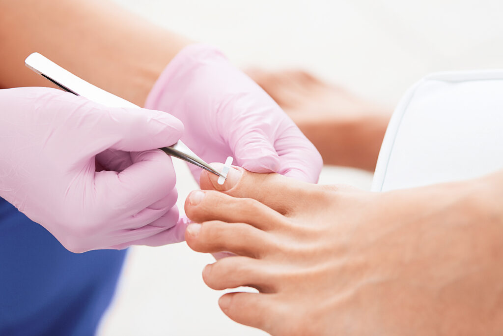 Mâini cu mănuși efectuând o procedură de îngrijire a unghiilor la Wanderma Clinic