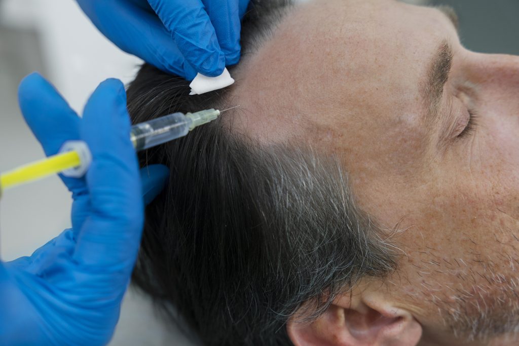 Injectare PRP în scalp pentru regenerarea părului la Wanderma Clinic
