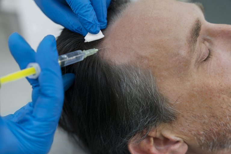 Injectare PRP în scalp pentru regenerarea părului la Wanderma Clinic