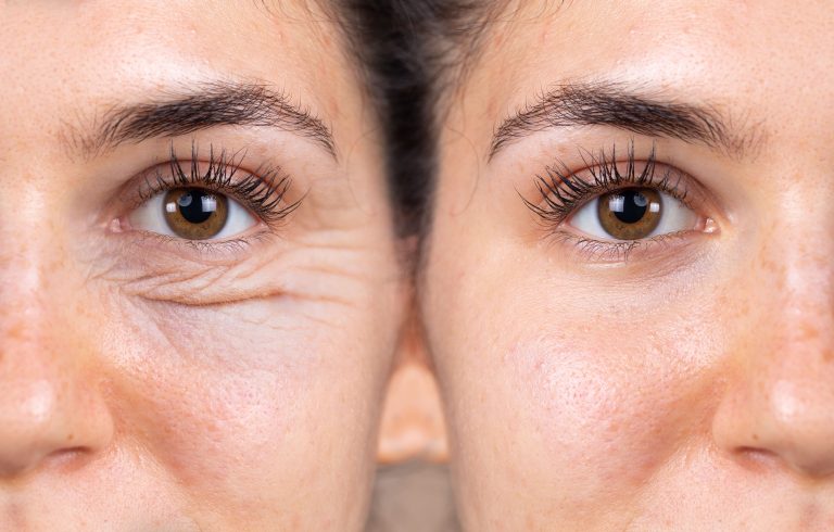 Blefaroplastie chirurgicală în Craiova, la Wanderma Clinic - chirurgie plastică