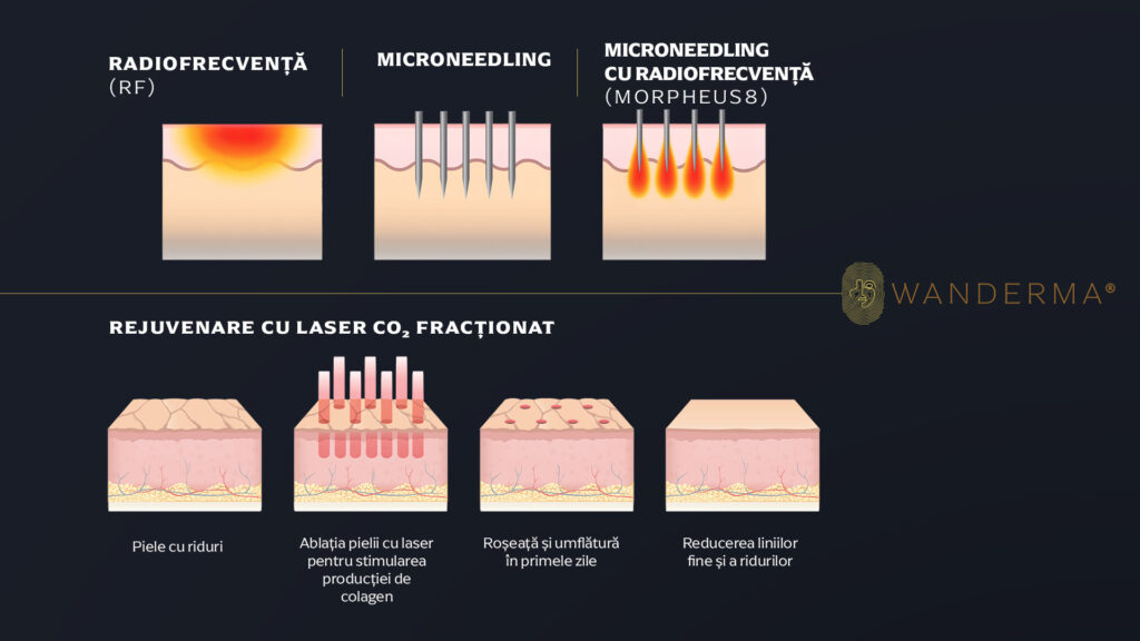 Microneedling vs. Laser